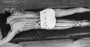 Myotherapy, Trigger Points, and Sciatica