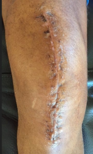 Scar tissue, knee