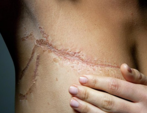 Mastectomy scar