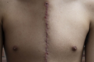 Open heart surgery scar
