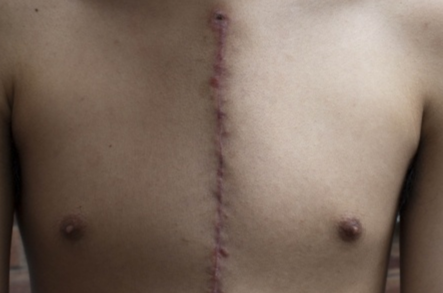 Scars Of Life Bonnie Prudden Educational Institute